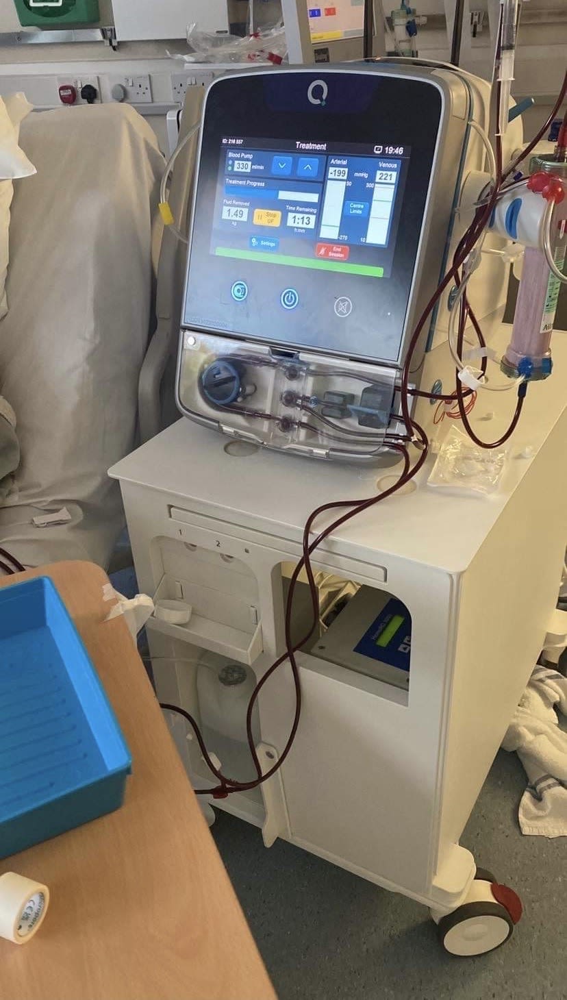 Dialysis machine extracting the waste and excess fluid from Emily's body
